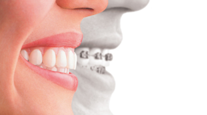 5 Kelebihan Aligner untuk Meratakan Gigi