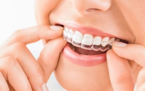 5 Kelebihan Aligner untuk Meratakan Gigi